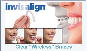 invisalign clear braces