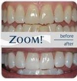 zoom teeth whitening